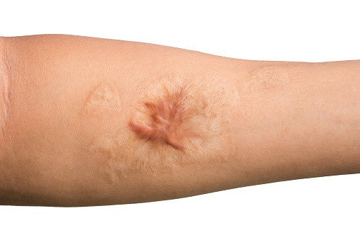 How to Treat a Scar From a Burn