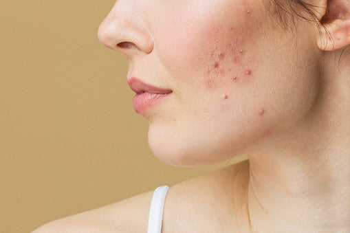 5 Natural Ways to Reduce the Appearance of Scars on Your Face