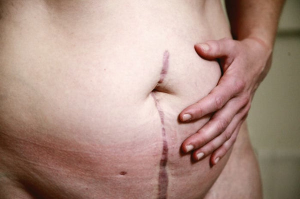 7 Tips on How to Minimize Scars After Surgery