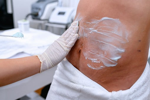 How to Properly Care for Your Surgery Scar: When is it Safe to Apply Lotion?