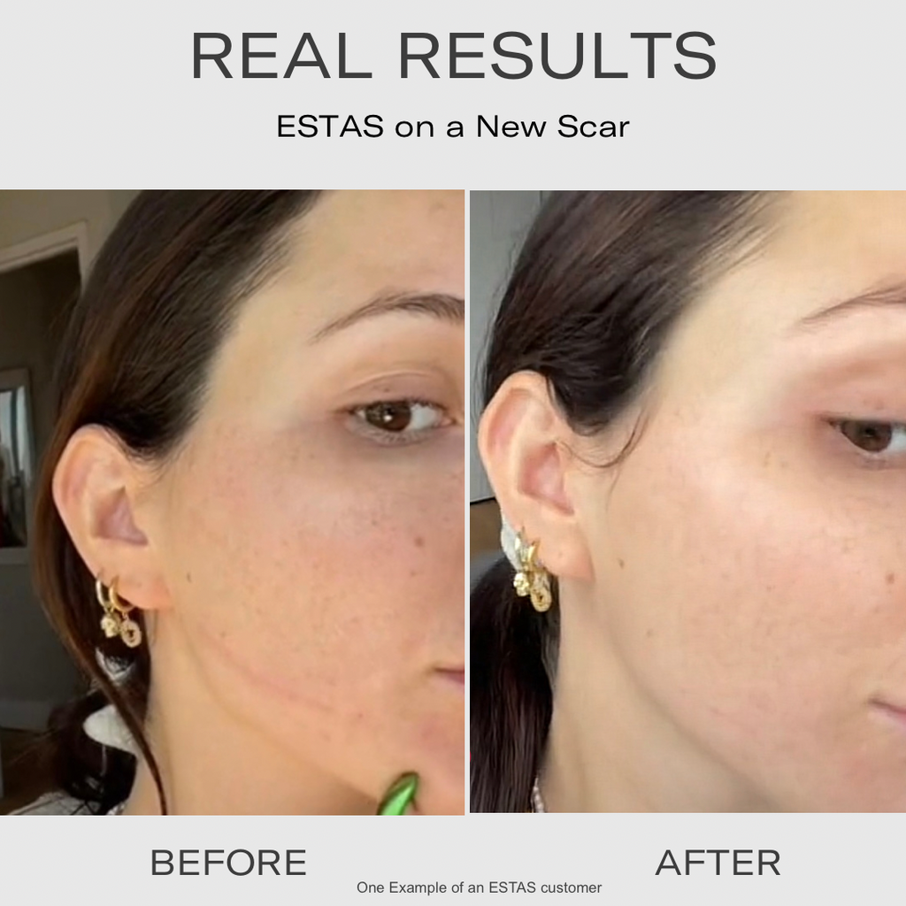 Vitamin e hot sale cream for scars
